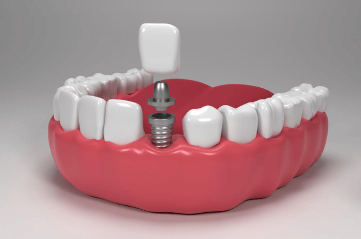Immediate Dental Implants